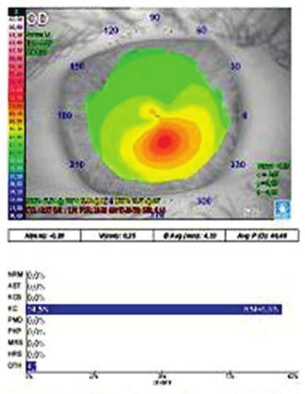 Importância da tomografia de córnea para o diagnóstico de ectasia 307 Figura 6: Topografia