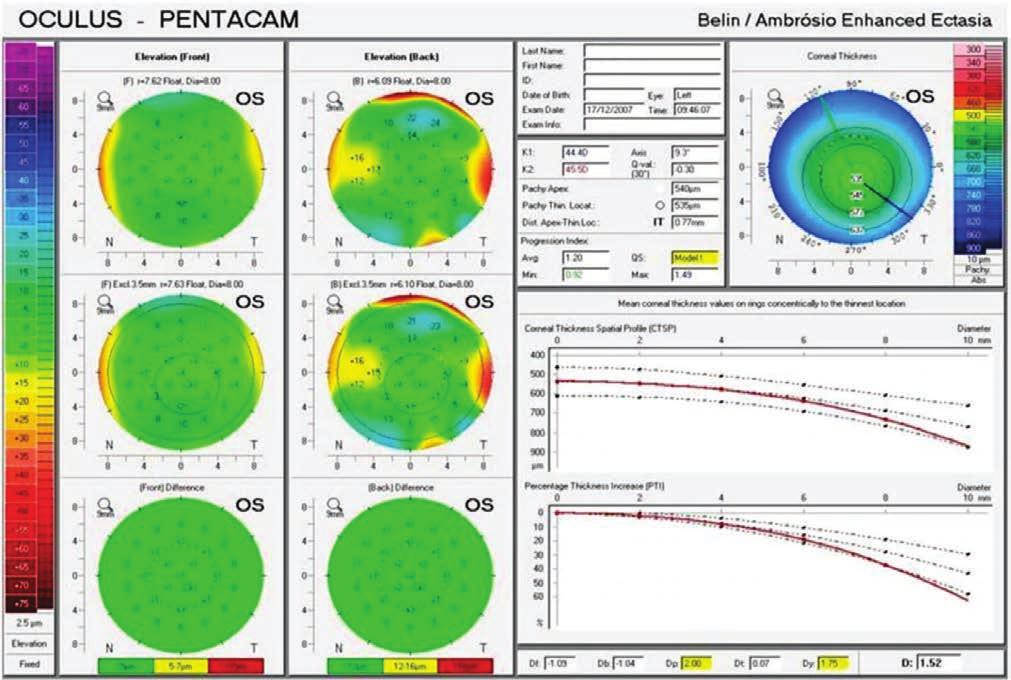 assimétrico com aspecto topográfico normal, conforme na figura 6; Notamos, curva de