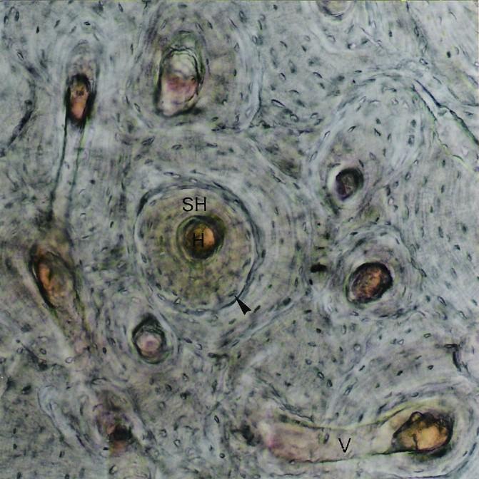 ATLAS DIGITAL DE BIOLOGIA CELULAR E TECIDUAL SH H v Figura 3.29 - Fragmento de osso compacto, mostrando sistemas de Havers (SH), canais de Havers (H), canais de Volkmann (V) e lacunas ( ).