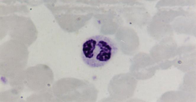 TATIANA MONTANARI Figura 3.36 - Eosinófilo. Giemsa. Objetiva de 100x (1.373x). maduro, com o núcleo segmentado em lóbulos, é referido nos hemogramas como segmentado.