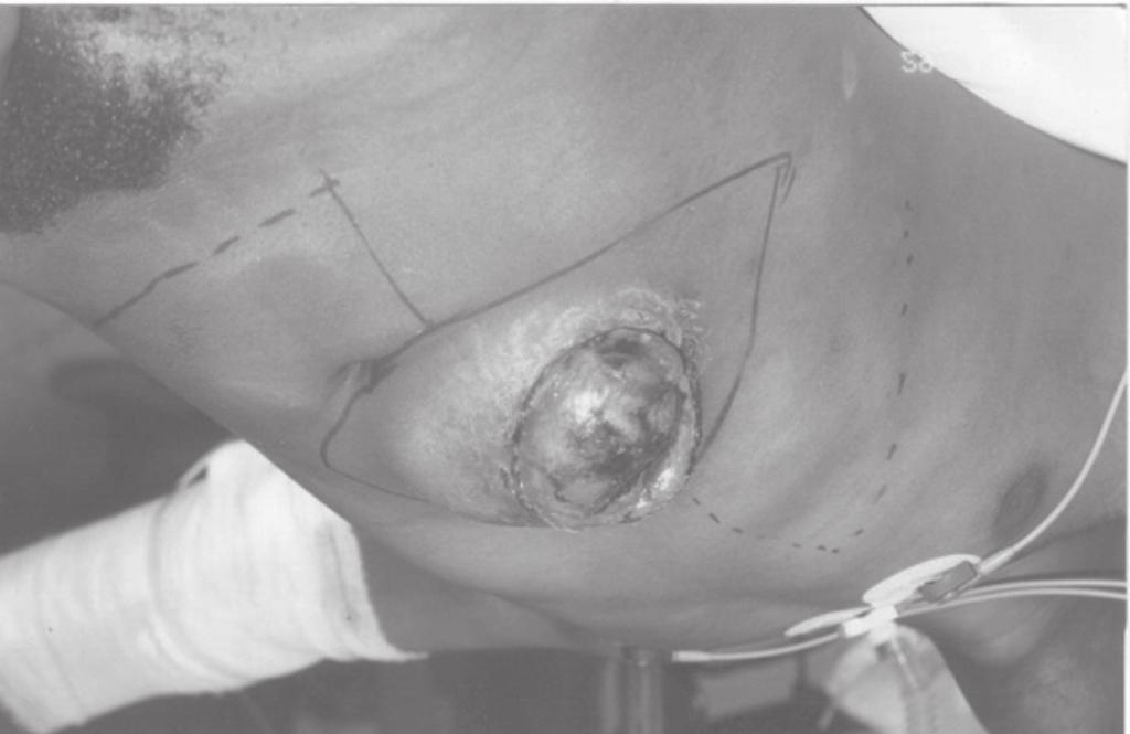De r m at o f i b r o s s a r c o m a Figura 1. Grande lesão nodular com ulceração central e hemorragia compatível com dermatofibrossarcoma protuberante em região abdominal (caso 1). (figura 2).