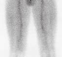 C) Imagem tardia com hipercaptação discreta (seta) no terço médio-distal do fêmur esquerdo. D) TC mostrando formação discreta do calo ósseo.