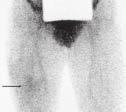 B) Imagem de equilíbrio mostrando aumento moderado da radioatividade no terço distal do fêmur direito (seta).