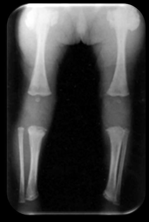 32 Figura 2 Raio-x de membros inferiores de recém-nascido, mostra calos ósseos nas extremidades FONTE: (ALVARES; MEZZECAPPA; POTERIO, 2002) Os ossos do crânio podem evoluir para a hiperostose, que é