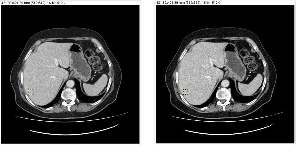 À direita: imagem clínica virtual do 5º Doente simulada a 91,7 ma (Io-33%) com corte localizado a -258,5 mm e ROI utilizada.