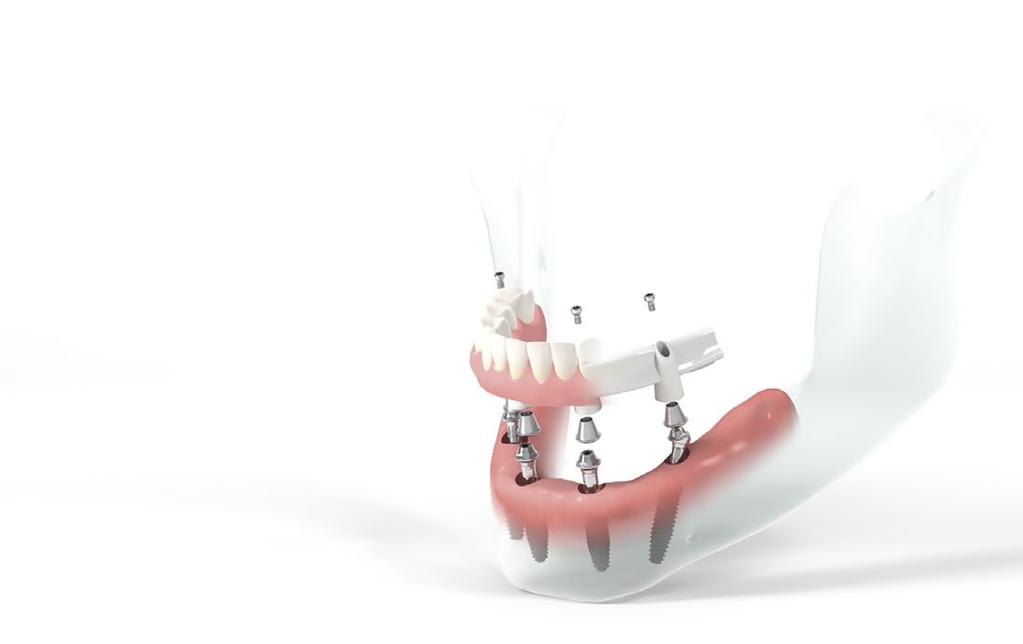 Straumann Pro Arch é uma solução abrangente que oferece uma grande gama de opções em implantes, pilares, estruturas CADCAM, barras, pontes e outros componentes que permitem aos dentistas e técnicos
