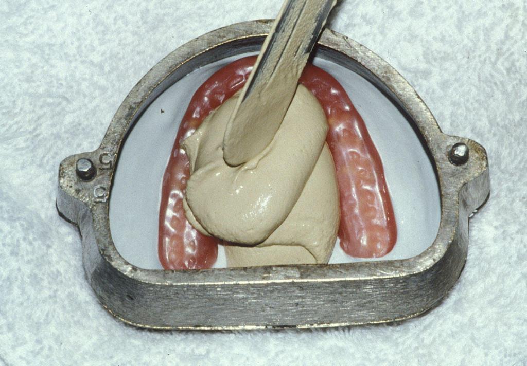 Figura 3 - Avaliação dos contatos oclusais e confecção da guia canina. As superfícies fora dos contatos oclusais foram deixadas lisas e polidas, com ausência de excessos de contorno.