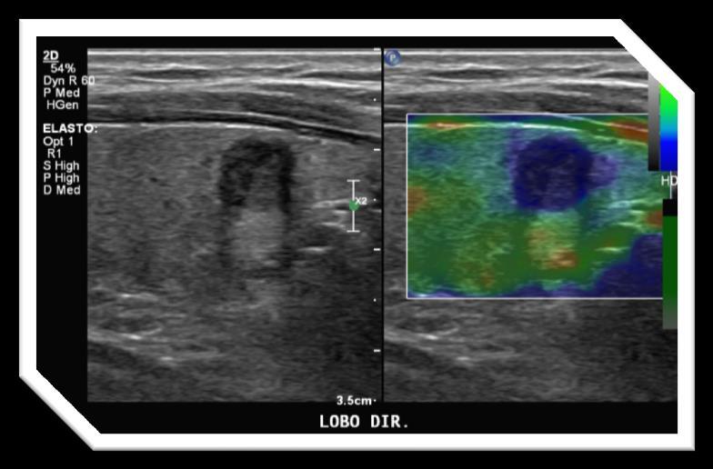 nódulo; à direita, elastografia demonstrando que a técnica possibilita o