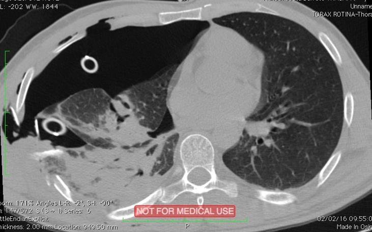 34 Ilustração 6- Corte axial da Tomografia Computadorizada na janela para parênquima pulmonar antes da correção cirúrgica definitiva (1) Fonte: Roraima, 2016.