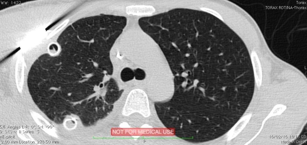 39 Ilustração 8 - Corte axial da Tomografia Computadorizada na janela para parênquima pulmonar após a correção cirúrgica definitiva (1) Fonte: Roraima, 2016.