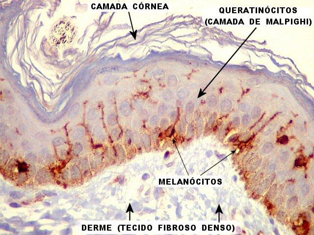 Melanócitos Melanócitos corados por Imunoistoquímica: