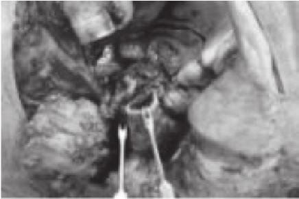 Foram realizadas 16 cirurgias para tumores de cabeça e pescoço com defeitos cirúrgicos de cavidade oral e orofaringe em que utilizamos o retalho de glândula submandibular para a correção.