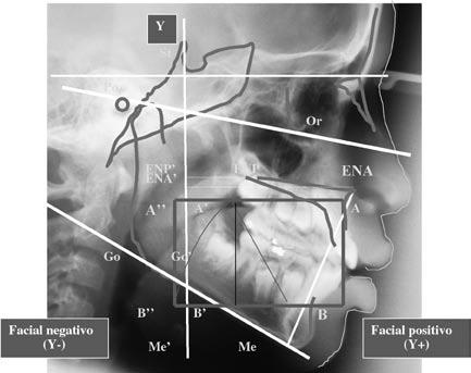 FIGURA 1 Desenho anatômico e os referenciais cefalométricos utilizados na obtenção dos segmentos (fatores). 2.