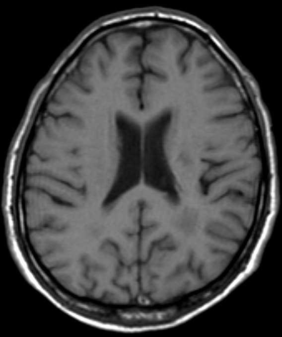 Figura 6 À esquerda tem uma imagem ponderada em T1, com boa resolução anatômica, com o líquido preto e uma boa diferenciação entre a substância branca e cinzenta.