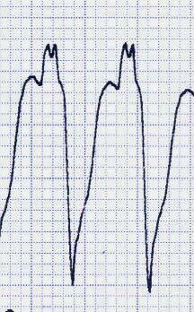 precordial?