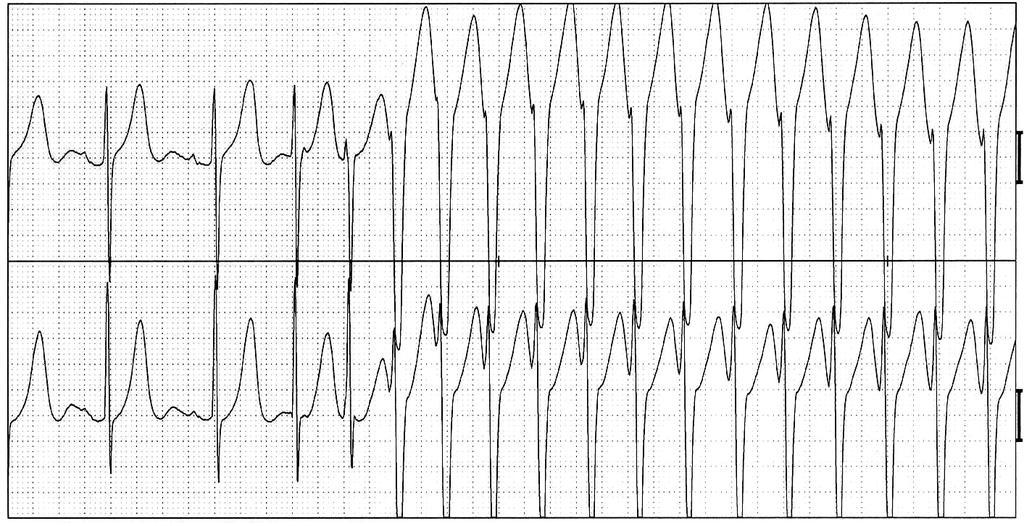 Taquicardia com QRS largo V1 V5 Presença de RS R-nadir S <100 Ausência de