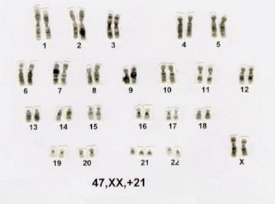 Mutações cromossómicas Numéricas Trissomia 21