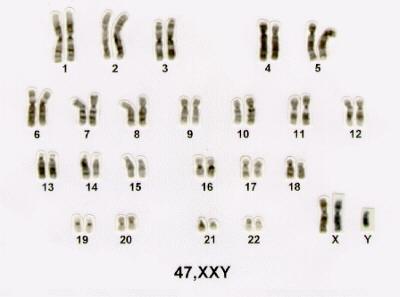 Mutações cromossómicas Numéricas Síndroma de Klinefelter (47, XXY) Testículos pouco desenvolvidos e com nenhuma ou reduzida produção de esperma.