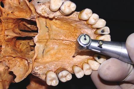 Garib, D. G.; Navarro, R. L.; Francischone, C. E.; Oltramari, P. V. P. A B C D FIGURA 2 - Procedimento cirúrgico para a instalação dos implantes para a ERMAI.