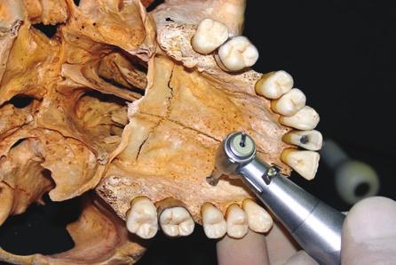 A seqüência cirúrgica segue os protocolos estabelecidos na literatura para a instalação de implantes utilizados na reabilitação protética 4, porém apenas uma fase cirúrgica se faz necessária.