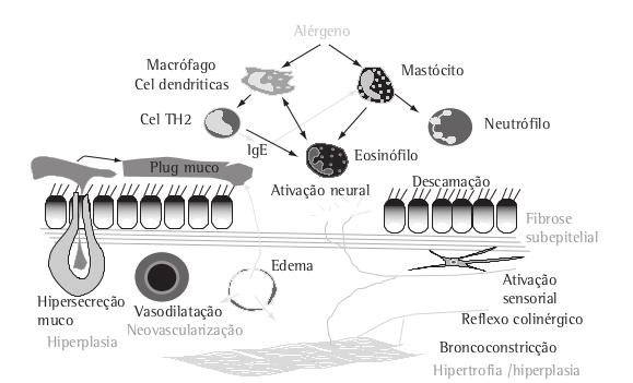 3. FISIOPATOLOGIA Diversos tipos celulares e mediadores químicos estão envolvidos na fisiopatologia da asma, como mastócitos, eosinófilos, linfócitos, células dendríticas, macrófagos e neutrófilos.