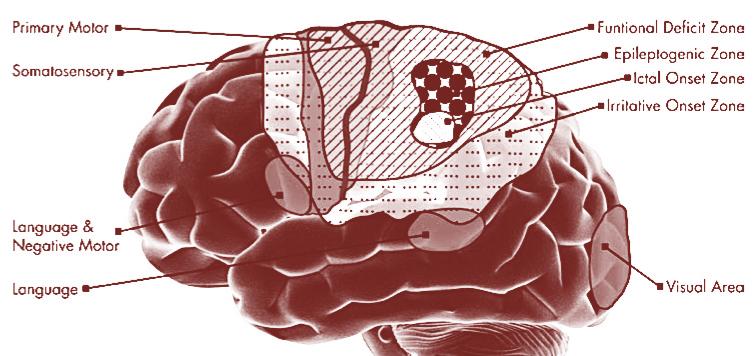 Zona Epileptogênica Ø Quantidade mínima de tecido cerebral que deve