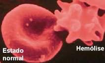 HEMÓLISE A hemólise aguda durante a diálise pode ser uma emergência clínica Sintomas: dorsalgia, sensação de aperto no tórax e dispnéia