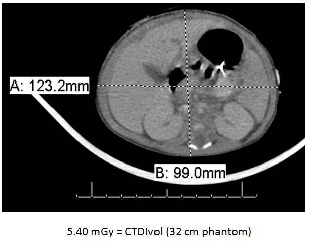 A. S. Capaverde, et. al. Braz. J. Rad. Sci. 2015 8 Tabela 1: Valores de referência para o CTDIvol, DLP e Dose Efetiva. CTDIvol (mgy) DLP (mgy.