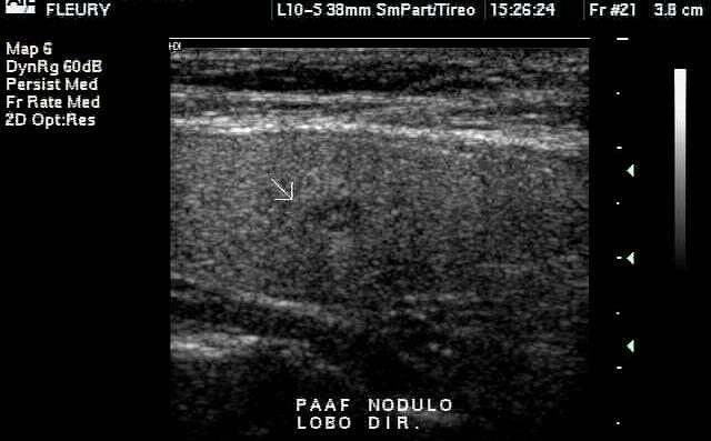 BMN Nódulos únicos são suspeitos Nódulo único e frio - 15 a 25%