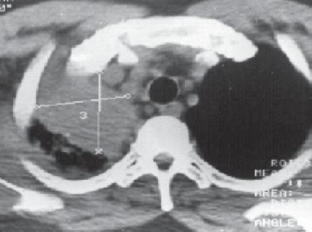 Biópsia a céu aberto: silicose; B) Tomografia computadorizada de alta resolução de tórax: volumosa opacidade no lobo superior direito, de contornos irregulares Dos 75 pacientes portadores de FMP, 44