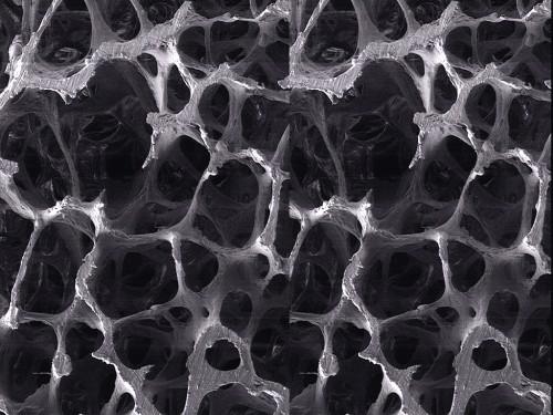 Osteoporose grave perda >2,5 DP + fratura instalada Osteomalácia acúmulo de tecido osteóide não mineralizado no osso trabecularqu resulta de uma deposição insuficiente de mineral no tecido.
