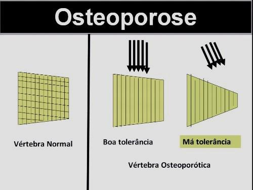 laboratório são normais para osteoporose.podemos dosar: 1. hormônio paratireoidiano 2. metabólicos para vitd 3.