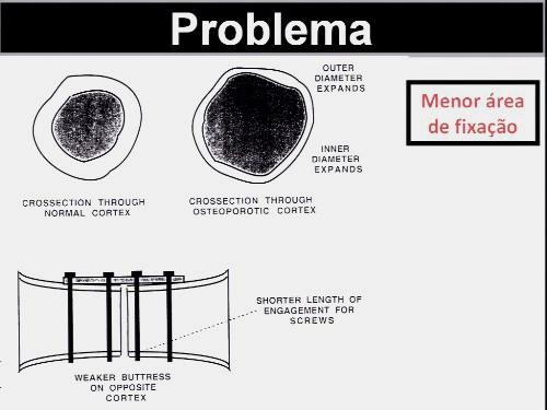 A terapia com estrogênio na pós-menopausa está associada com redução de 40%50% no risco de fraturas do quadril associada a doença e 90% no risco de fraturas vertebrais.