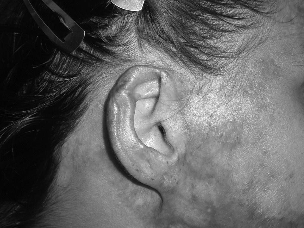 cartilagem, e em três outros pacientes usamos o retalho condrocutâneo, sendo que em dois destes últimos as duas técnicas foram associadas (Figuras 4a, 4b).