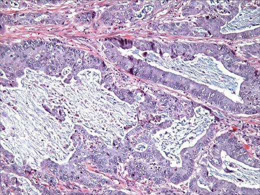 12 Fig. 3. Adenocarcinoma endocervical Células tumorais com abundante citoplasma mucinoso, lembrando glândulas endocervicais normais. Fonte: Elsevier Ltd.