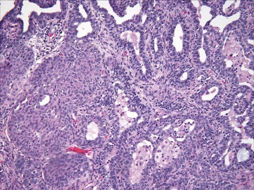 13 Figura: 4. Carcinoma Adenoescamoso. Note a diferenciação glandular e escamosa. Fonte: Elsevier Ltd. Fletcher: Diagnostic Histopathology of Tumor 7ª ed, 2001.