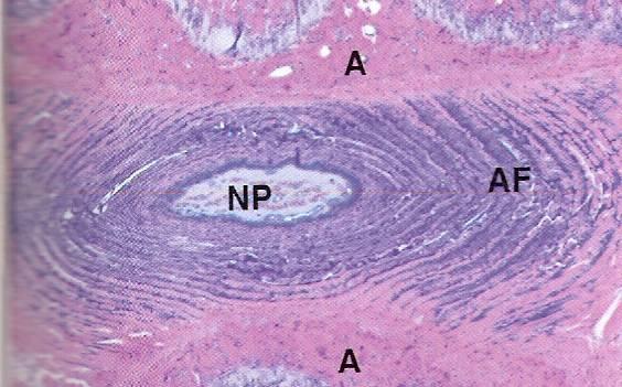 DISCO INTERVERTEBRAL Porções de cartilagem fibrosa localizada entre as vértebras Componentes: a) anel fibroso: possui porção periférica de tec. conj.