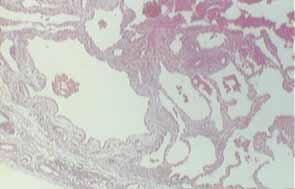 (d) Região sub-pleural com cisto de parede fibrosa e espaços aéreos adjacentes preenchidos por macrófagos. HE, 40x, feminina.