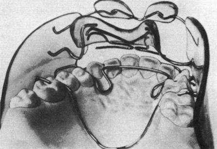 Alterações transversais com aparelhos funcionais Referências Aparelho N Idade Maxila Mandíbula 3-3 6-6 3-3 6-6 Frankel (1971) Frankel 400 - - 1,2 - - Mc Dougall et al.