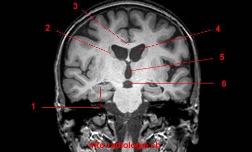 DIENCÉFALO É a região central do cérebro, recoberto pelos hemisférios e dividido em grande parte pelo terceiro ventrículo em