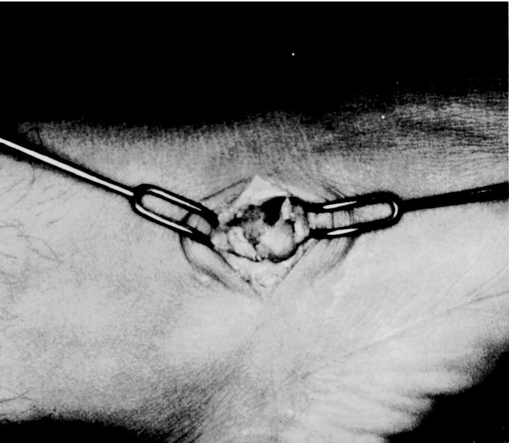 MÉTODO Desde 1980 estamos realizando, em nosso serviço, a implantação de prótese feita com cimento acrílico (metilmetacrilato), preparada e manipulada no ato cirúrgico, com forma e tamanho adequados