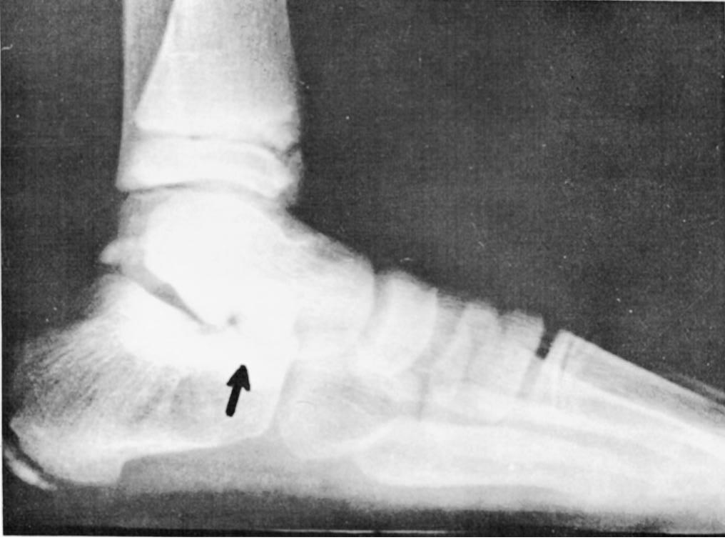 TRATAMENTO CIRÚRGICO DO PÉ PLANO VALGO: TÉCNICA PESSOAL Fig. 6 V.R.L., dez anos. Radiografia após dois anos de prótese colocada (vide seta). Fig. 4 Prótese já colocada no seio do tarso Fig. 7 V.