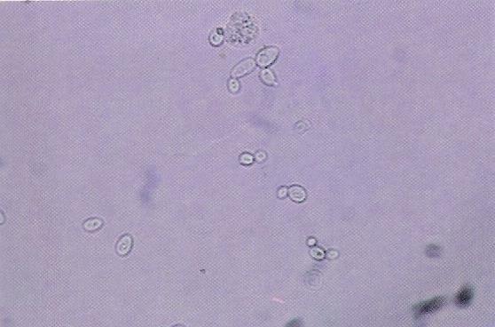 Leveduras Leucócito Brotamento Leveduras e um leucócito: formas em