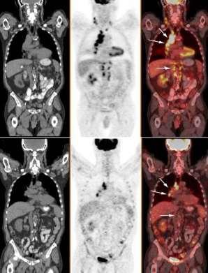 Figura 2 Neoplasia pulmonar maligna com metástase nodais (setas) demonstrada na primeira linha e redução da lesão após quimioterapia na segunda linha, imagens de CT na primeira coluna, PET na segunda