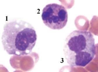 potencial leucemogénico da proteína de fusão PML-RARA, o desenvolvimento de leucemia requer a presença mútua desta oncoproteína com uma ou mais mutações genéticas adicionais - acreditando-se que
