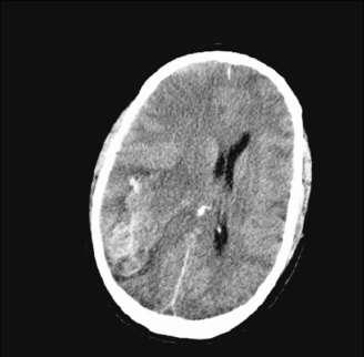 Figura 4. Corte axial de tomografia computorizada crânioencefálica sem contraste, num doente com LPA.
