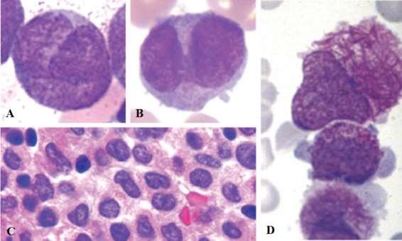 (Figura 6.C) e infiltrada por promielócitos - que constituem a população maioritária - com proeminente granulação citoplasmática (Figura 6.