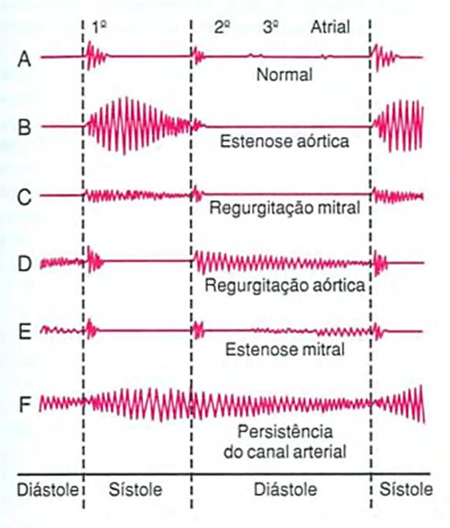 31 sincronismo durante o fechamento das valvas atrioventriculares e arteriais, que correspondem aos sons formadores da primeira e segunda bulha, respectivamente (GUYTON, 2006).