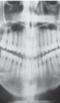 As principais áreas doadoras de enxerto ósseo utilizado na face são: costelas, calota craniana, crista ilíaca e parede anterior do seio maxilar 1.