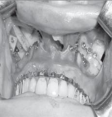 Observa-se gap intermaxilar à esquerda nos casos em que havia desnível intermaxilar, optando-se pela fixação do enxerto ósseo no lado da maxila em que houvesse o maior gap (espaço intermaxilar) -